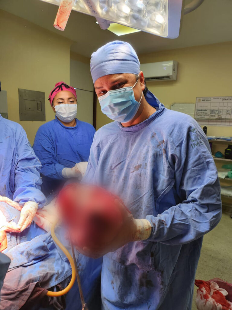 Extirpan especialistas de UMAE No. 14 del IMSS Veracruz Norte tumor maligno de 13 kilos