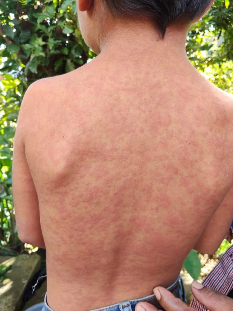 Alertan por brote de sarampión en comunidad de Cochoapa el Grande