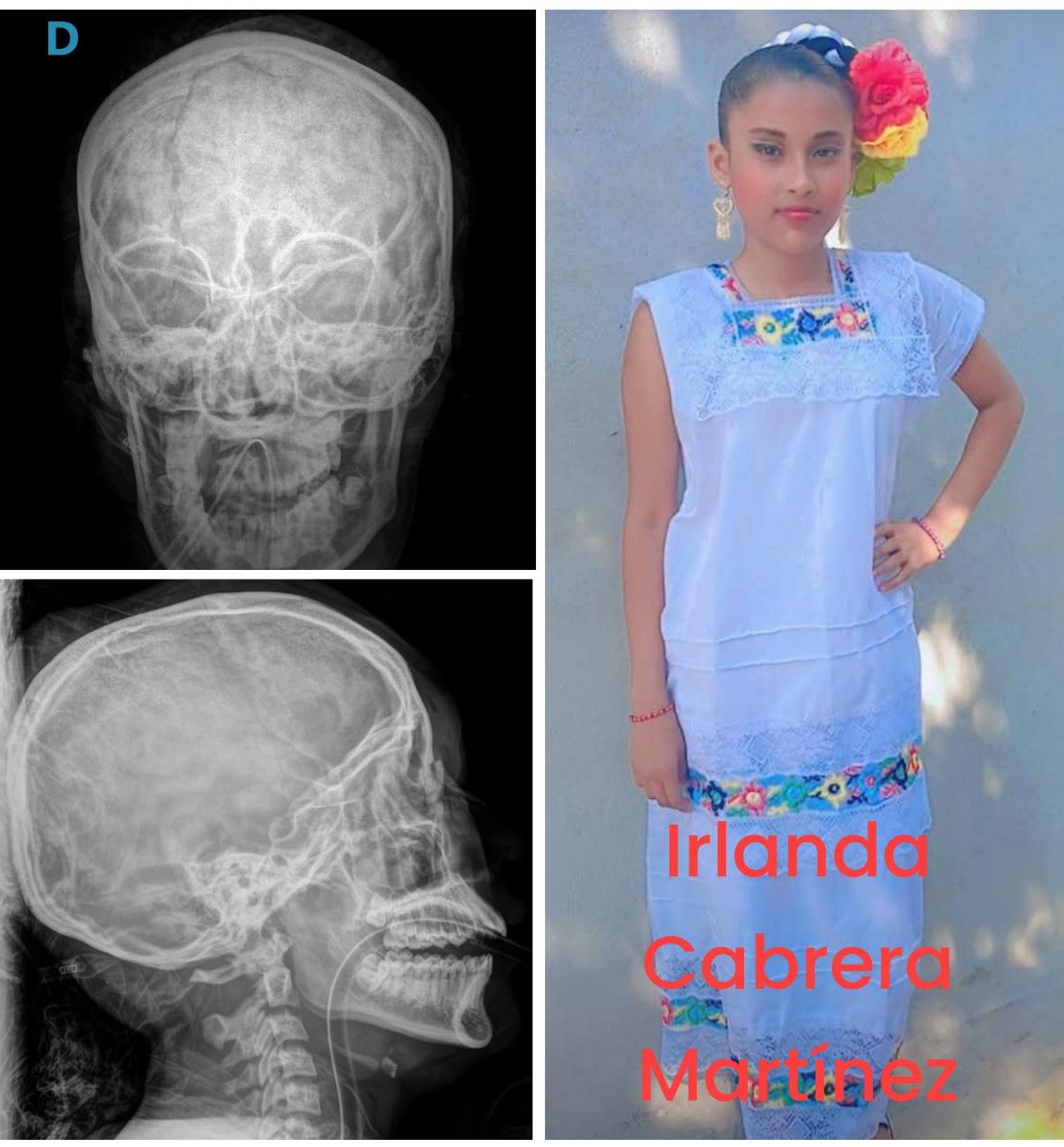 Familia solicita apoyo para menores lesionadas en accidente de cuatrimoto en San Jerónimo